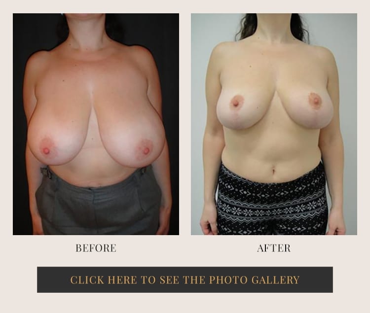 breast reduction Westchester NY - before and after