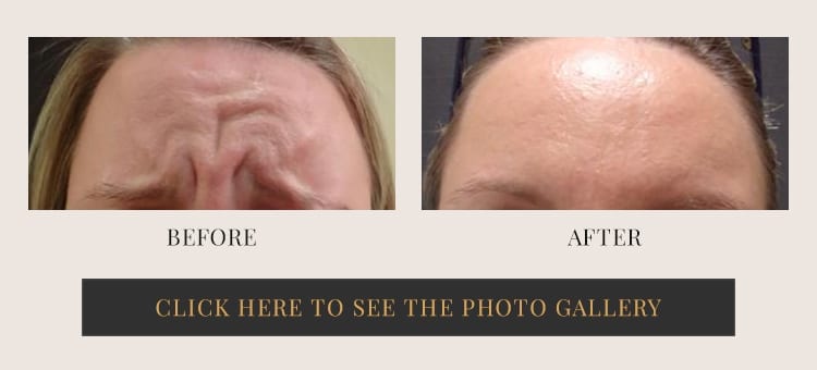 Before and after Dysport applied to the forehead