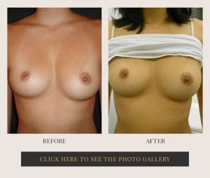 Liposuction in White Plains, New York | Top Rated in Westchester 22