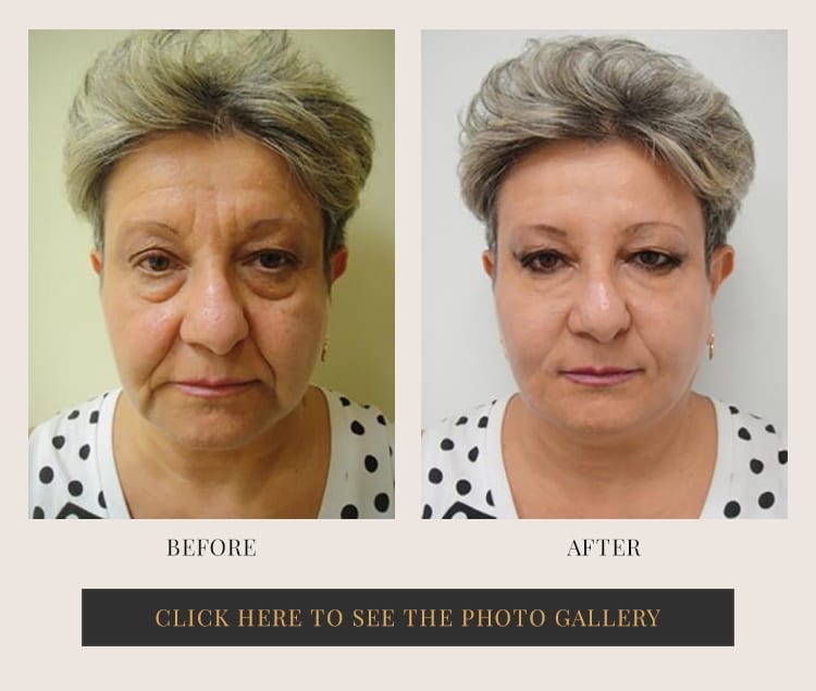 Before and after liquid facelift results