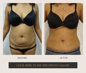 Liposuction in White Plains, New York | Top Rated in Westchester 29