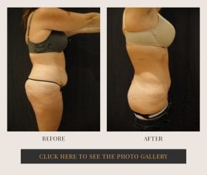 Liposuction in White Plains, New York | Top Rated in Westchester 30