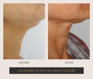 Liposuction in White Plains, New York | Top Rated in Westchester 33