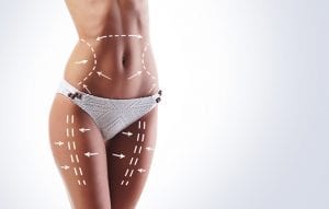 Westchester, NY woman shows liposuction results
