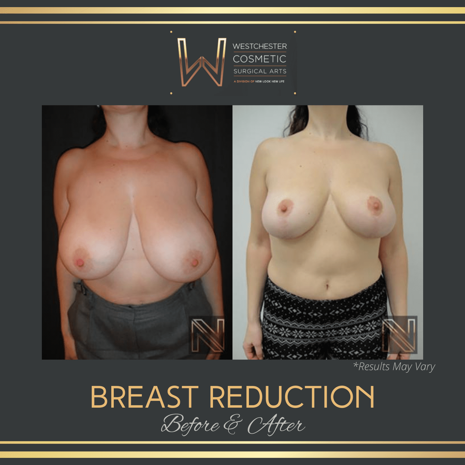 Before and after image showing the results of a breast reduction performed in Westchester, NY.